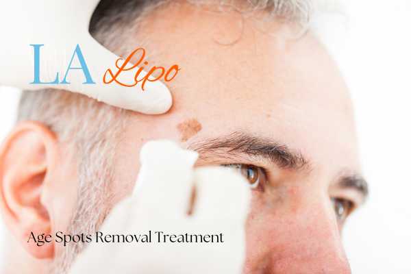 What Are the Most Effective Treatments for Age Spots Bedford?