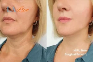hi-fu for wrinkles Bedford before and after results