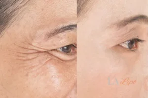 Before and after results of woman - HI-fu wrinkles reduction treatment Bedford