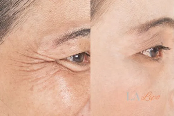 Before and after results of woman - HI-fu wrinkles reduction treatment Bedford