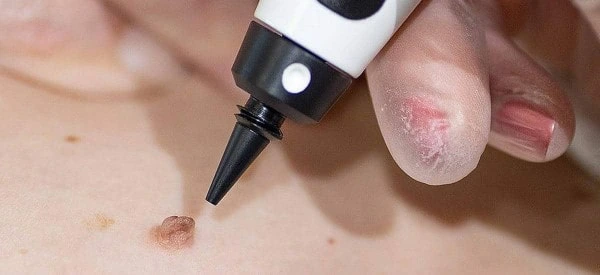 skin tag removal using cryopen Bedford