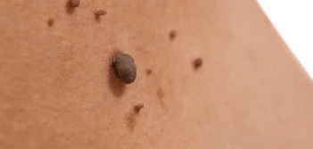 image of a skin tag Bedford
