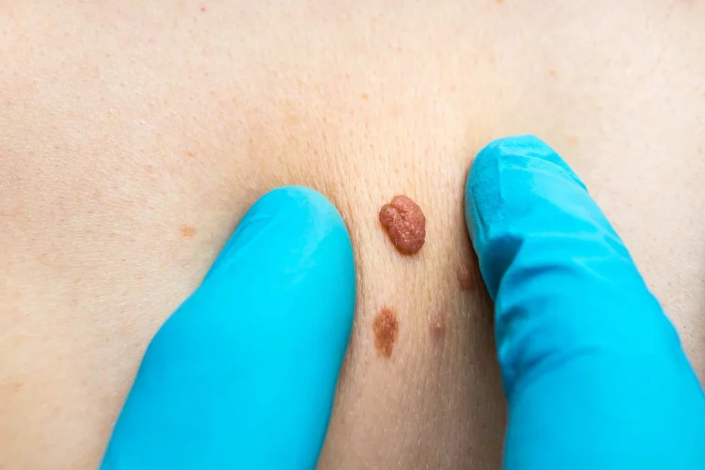 Consultant examining a skin tag Bedford