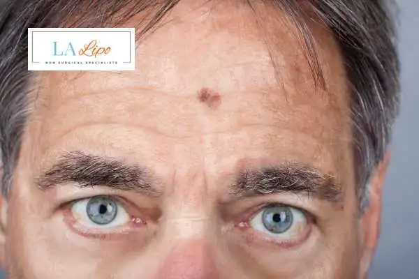 Solar Lentigo Removal Bedford image of man with mark on his forehead