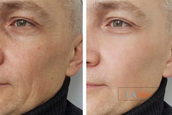 See the amazing results of Morpheus8 Treatment Bedford!