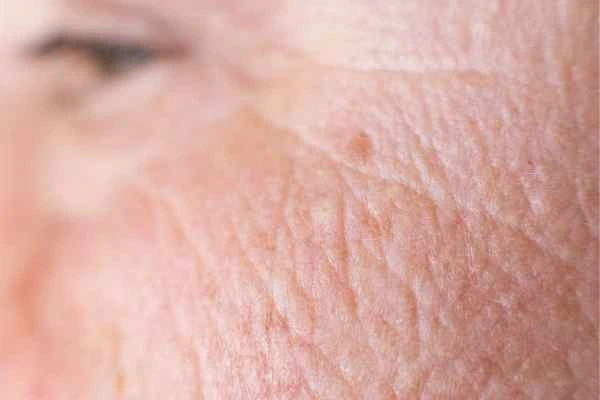 close up picture of a woman's face showing an age spot Bedford