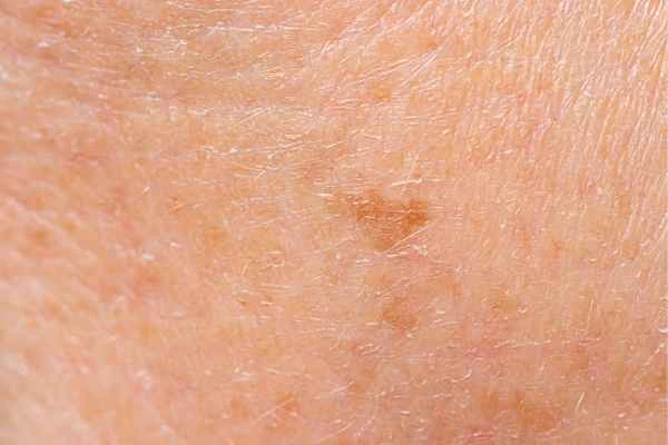 close up picture of age spots Bedford