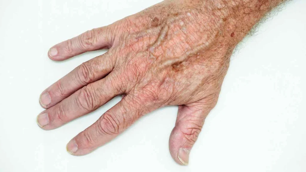Male hand showing age spot Bedford