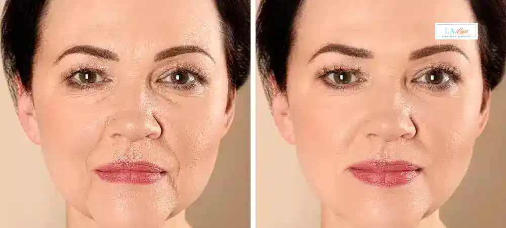 How Long Does It Take to See Results and How Long Do They Last Bedford?