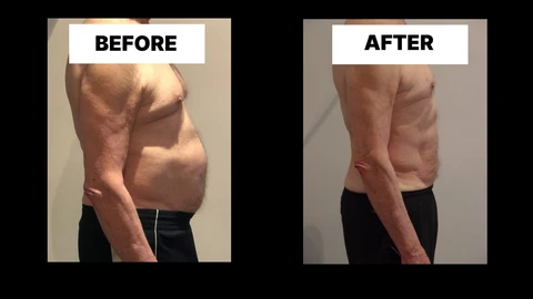 What Symptoms Can Diastasis Recti Cause in Men? Weak Core, Back Pain and Poor Posture Bedford